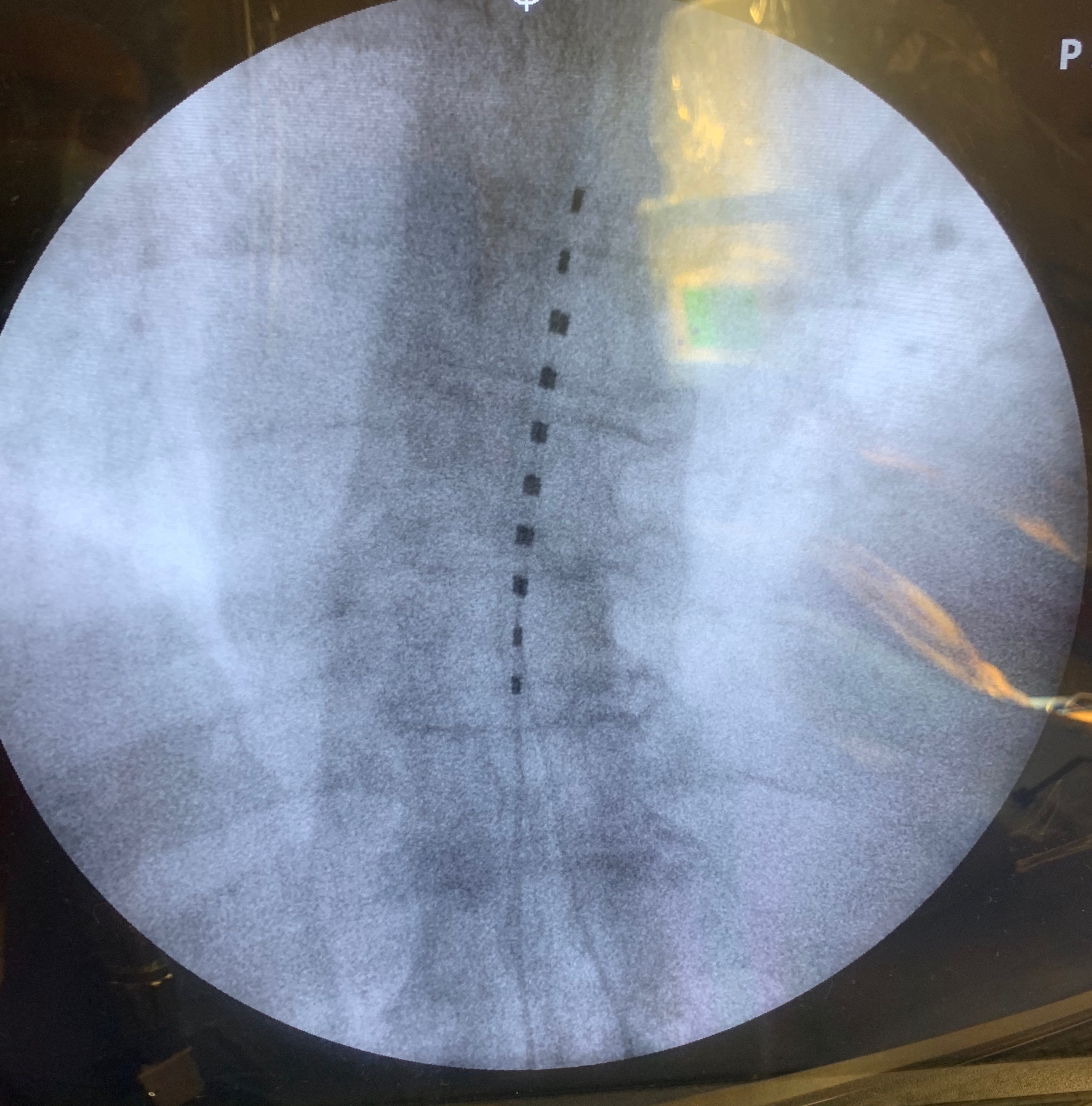 spinal cord stimulator implant pictures